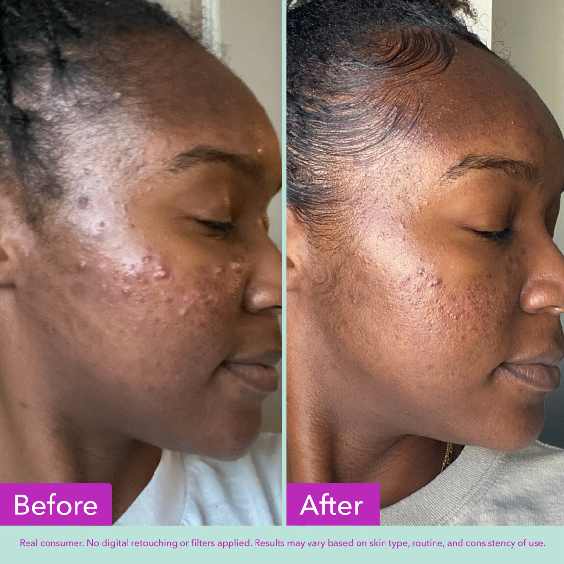 acne-foaming-cleanser-w7 zb_p.jpg